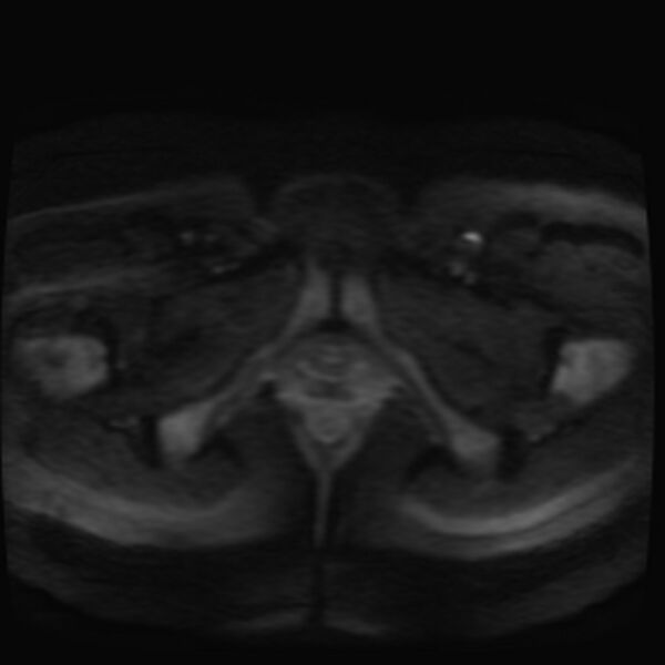 File:Adenomyosis on MRI (Radiopaedia 29328-29780 Axial DWI 15).jpg