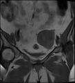 Adnexal multilocular cyst (O-RADS US 3- O-RADS MRI 3) (Radiopaedia 87426-103754 Coronal 12).jpg