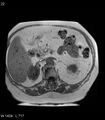 Adrenal myelolipoma (Radiopaedia 6765-7961 Axial T1 in-phase 22).jpg