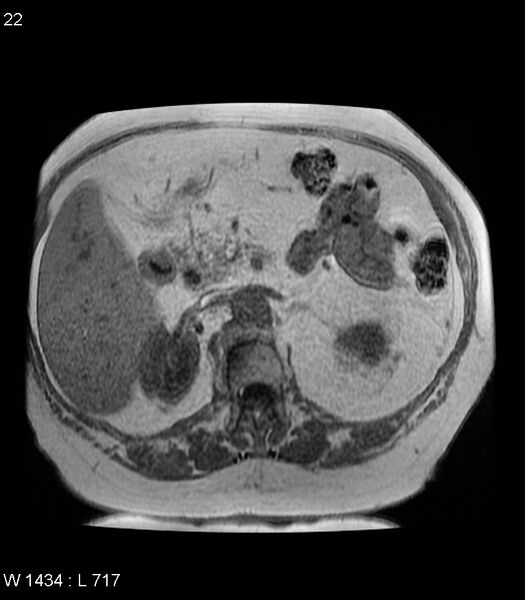 File:Adrenal myelolipoma (Radiopaedia 6765-7961 Axial T1 in-phase 22).jpg
