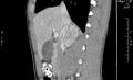 Adrenal pheochromocytoma (Radiopaedia 35133-36726 Sagittal C+ portal venous phase 4).jpg