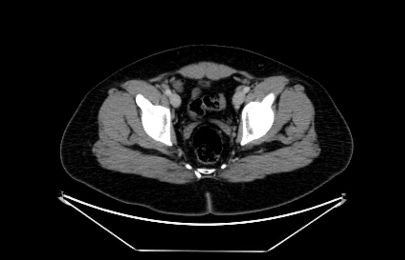 File:Adrenocortical carcinoma (Radiopaedia 80134-93438 Axial C+ portal venous phase 120).jpg
