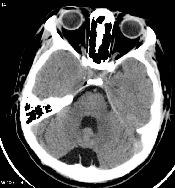 File:Aicardi syndrome (Radiopaedia 5353-7116 Axial non-contrast 11).jpg