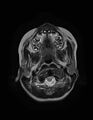 Aicardi syndrome (Radiopaedia 66029-75205 Axial T2 1).jpg