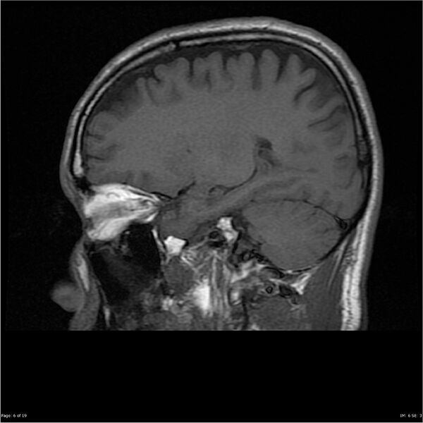 File:Amnestic syndrome secondary to hypoxic brain injury (Radiopaedia 24743-25004 T1 6).jpg