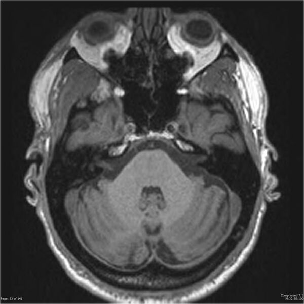 File:Anaplastic meningioma with recurrence (Radiopaedia 34452-35788 Axial T1 30).jpg