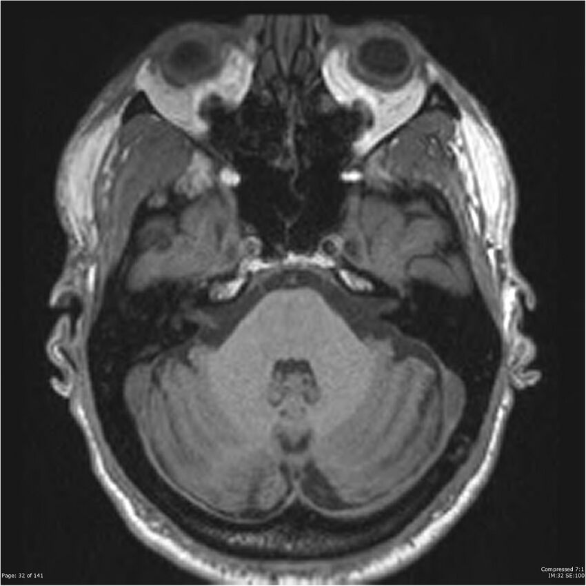 Anaplastic meningioma with recurrence (Radiopaedia 34452-35788 Axial T1 30).jpg