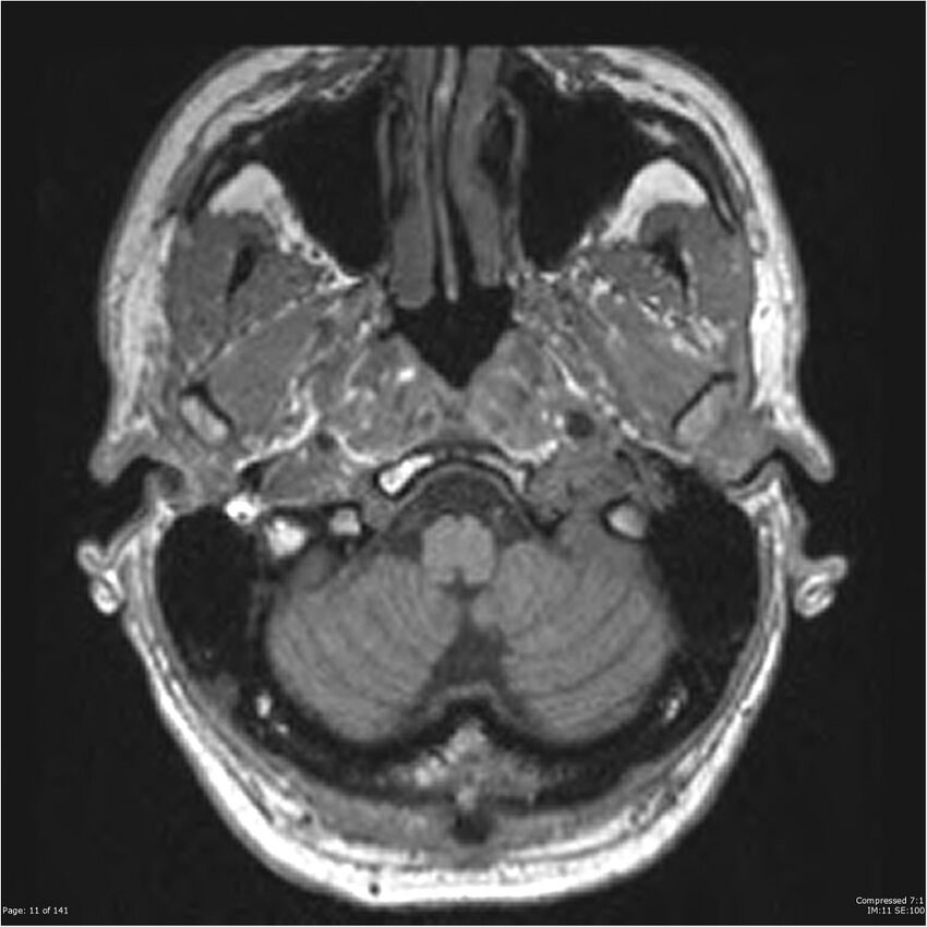 Anaplastic meningioma with recurrence (Radiopaedia 34452-35788 Axial T1 9).jpg