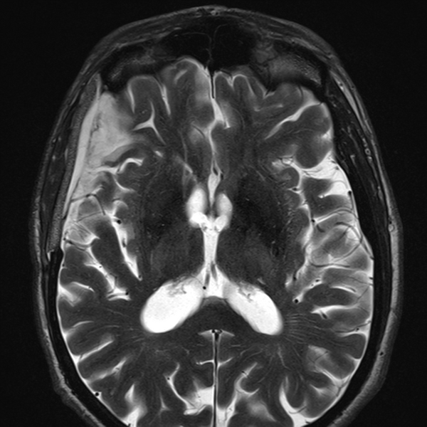 File:Anaplastic meningioma with recurrence (Radiopaedia 34452-35788 Axial T2 13).png