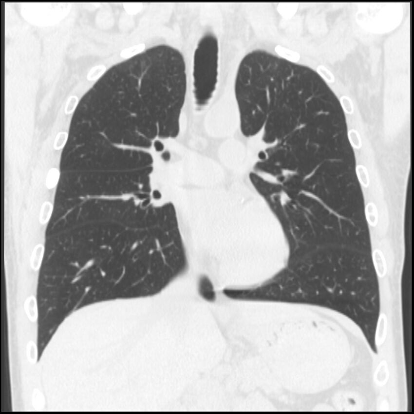 Angioinvasive aspergillosis (Radiopaedia 43957-47466 Coronal lung window 52).jpg