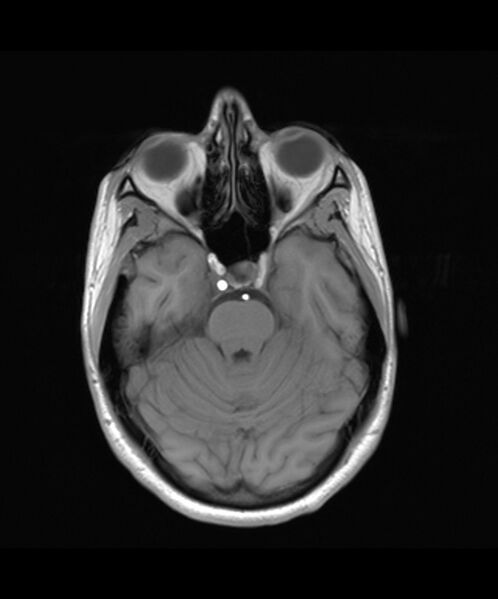 File:Angiomatous meningioma (Radiopaedia 79459-92579 Axial T1 8).jpg