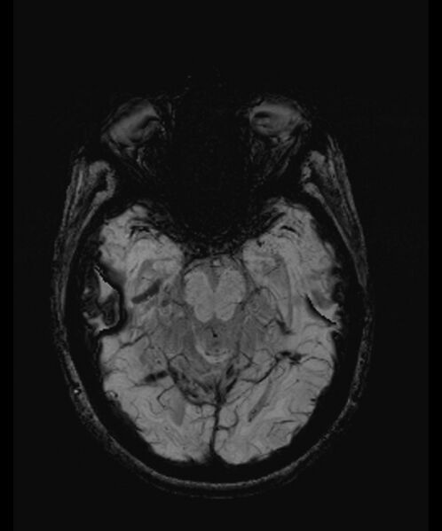 File:Angiomatous meningioma (Radiopaedia 79459-92579 E 22).jpg