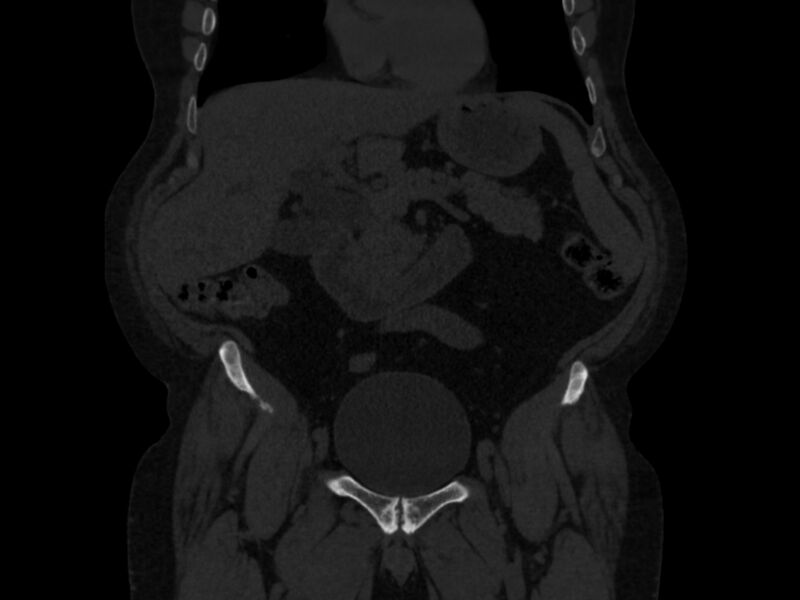 File:Ankylosing spondylitis (Radiopaedia 44609-48357 Coronal bone window 4).jpg