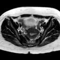 Ano-vaginal fistula (Radiopaedia 29765-30284 Axial T2 22).jpg