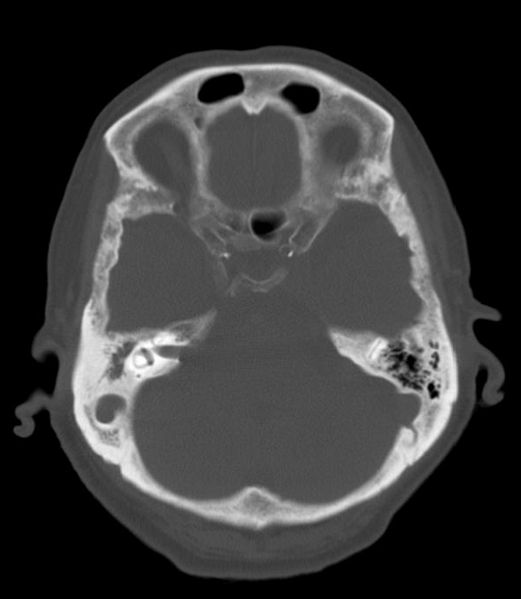 File:Anomalous intracranial venous drainage (Radiopaedia 28161-28418 Axial 1).png