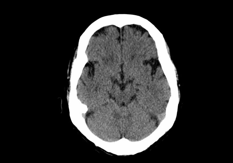 File:Anomalous intracranial venous drainage (Radiopaedia 28161-28418 Axial non-contrast 16).jpg