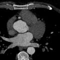 Anomalous origin of the left coronary artery with malignant course (Radiopaedia 77842-90126 C 76).jpeg