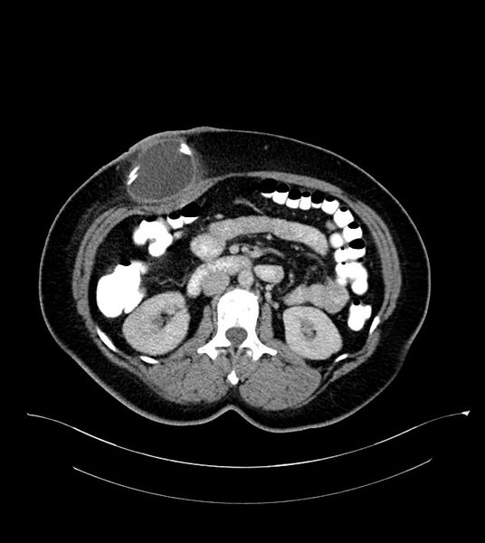 File:Anterior abdominal wall CSF pseudocyst (CSFoma) (Radiopaedia 79453-92571 A 42).jpg