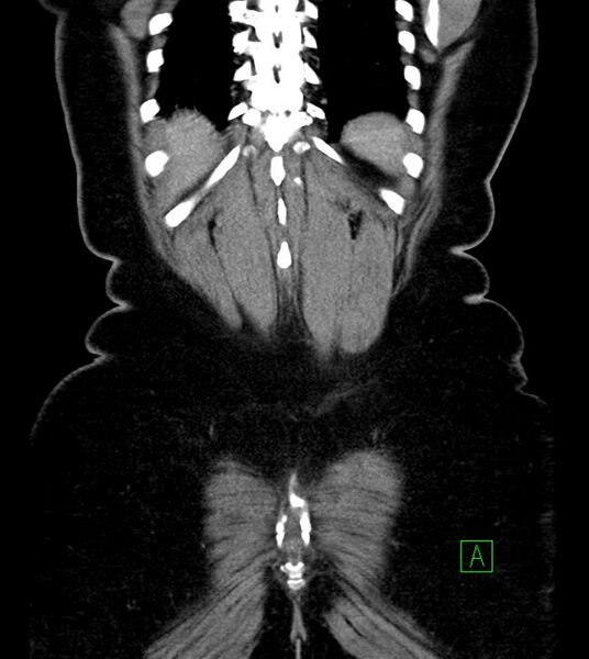 File:Anterior abdominal wall CSF pseudocyst (CSFoma) (Radiopaedia 79453-92571 B 49).jpg