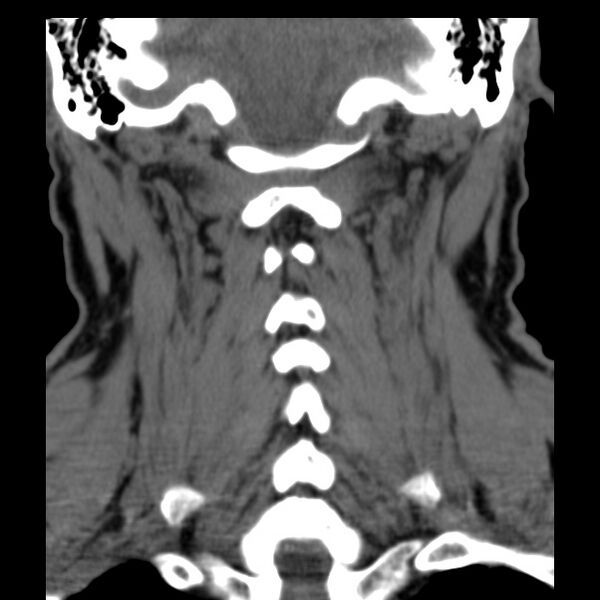 File:Anterior cervical postdiscectomy arthrodesis (Radiopaedia 32678-33646 Coronal non-contrast 26).jpg