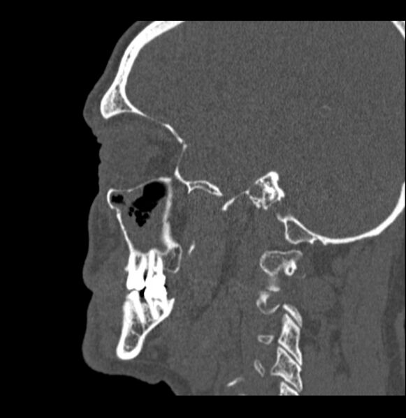 File:Antrochoanal polyp (Radiopaedia 79011-92169 Sagittal bone window 1).jpg