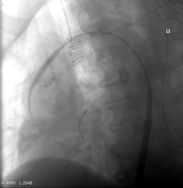 File:Aortic arch false aneurysm (Radiopaedia 14667-14589 Deployment of graft. 3).jpg