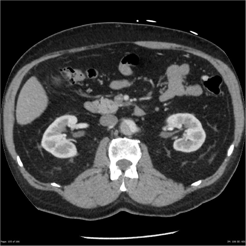 Aortic dissection- Stanford A (Radiopaedia 37759-39664 A 96).jpg