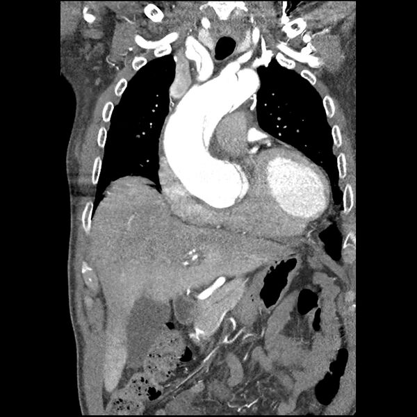 File:Aortic dissection - DeBakey Type I-Stanford A (Radiopaedia 79863-93115 B 13).jpg
