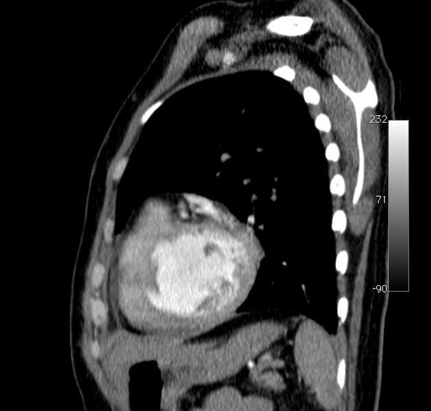 File:Aortic dissection - Stanford type A (Radiopaedia 29247-29659 C 8).jpg