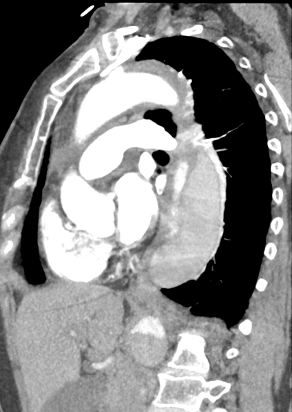 File:Aortic dissection - Stanford type B (Radiopaedia 50171-55512 C 24).png