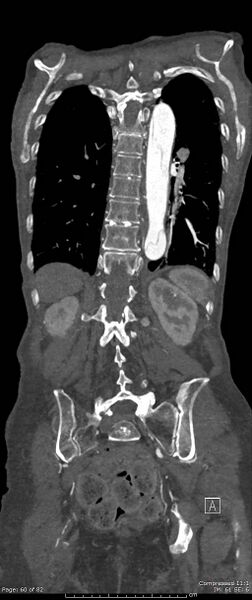 File:Aortic dissection with extension into aortic arch branches (Radiopaedia 64402-73204 A 60).jpg