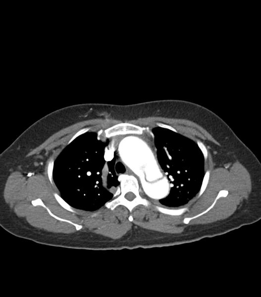 File:Aortic dissection with renal ischemia (Radiopaedia 76573-88338 A 15).jpg