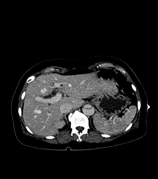 File:Aortic dissection with renal ischemia (Radiopaedia 76573-88338 B 24).jpg