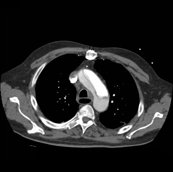 File:Aortic dissection with rupture into pericardium (Radiopaedia 12384-12647 A 17).jpg