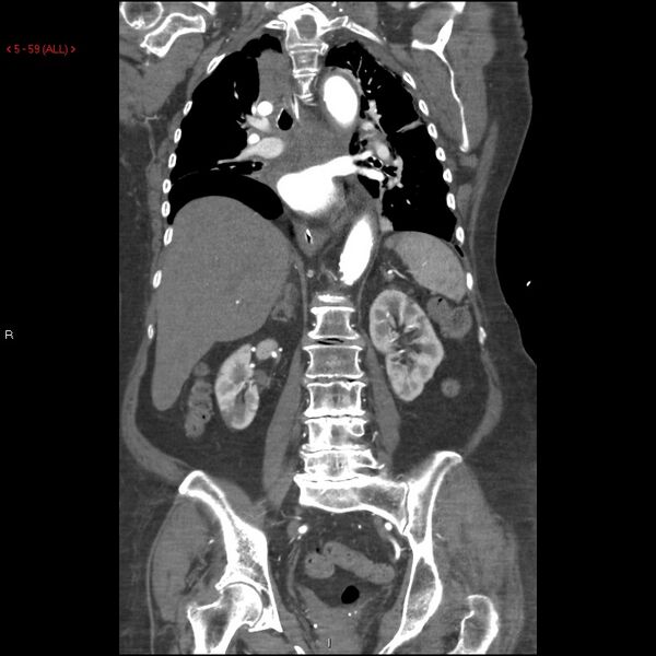 File:Aortic intramural hematoma (Radiopaedia 27746-28001 B 36).jpg