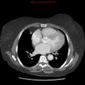 Aortic valve stenosis (Radiopaedia 14480-14423 C 10).jpg