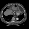 Aorto-coronary bypass graft aneurysms (Radiopaedia 40562-43157 A 96).png