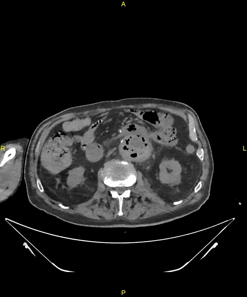 Aortoenteric fistula (Radiopaedia 84308-99603 Axial non-contrast 151).jpg