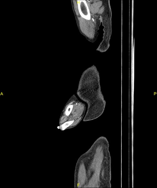 File:Aortoenteric fistula (Radiopaedia 84308-99603 C 4).jpg