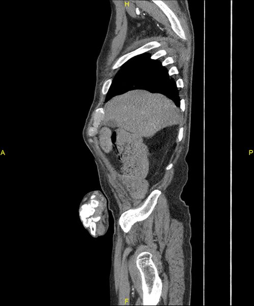 File:Aortoenteric fistula (Radiopaedia 84308-99603 C 52).jpg