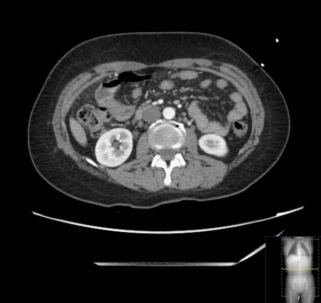 File:Appendicitis (CT angiogram) (Radiopaedia 154713-127660 Axial 95).jpg