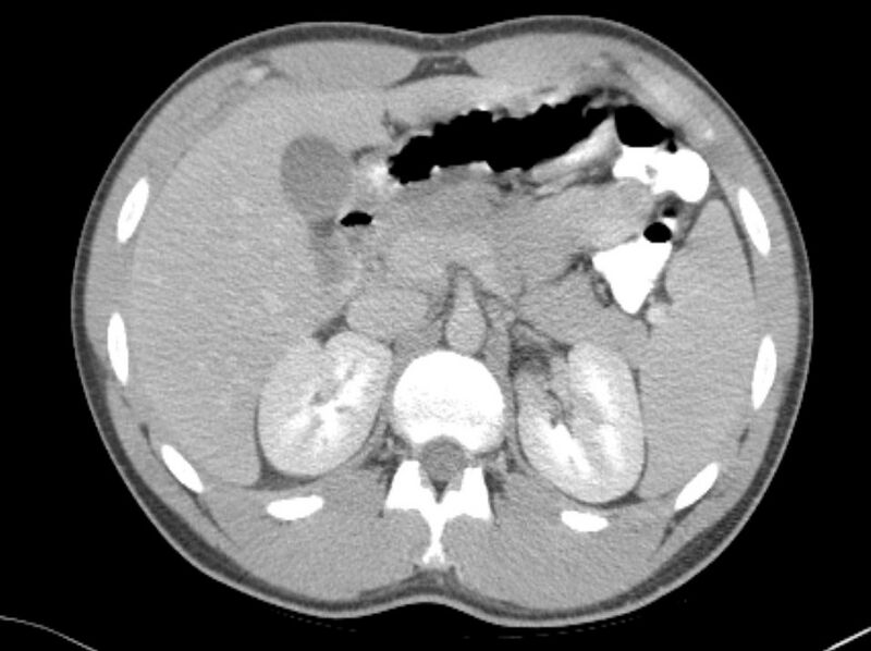 File:Appendicitis and incidental foregut duplication cyst (Radiopaedia 52962-58916 A 6).jpg