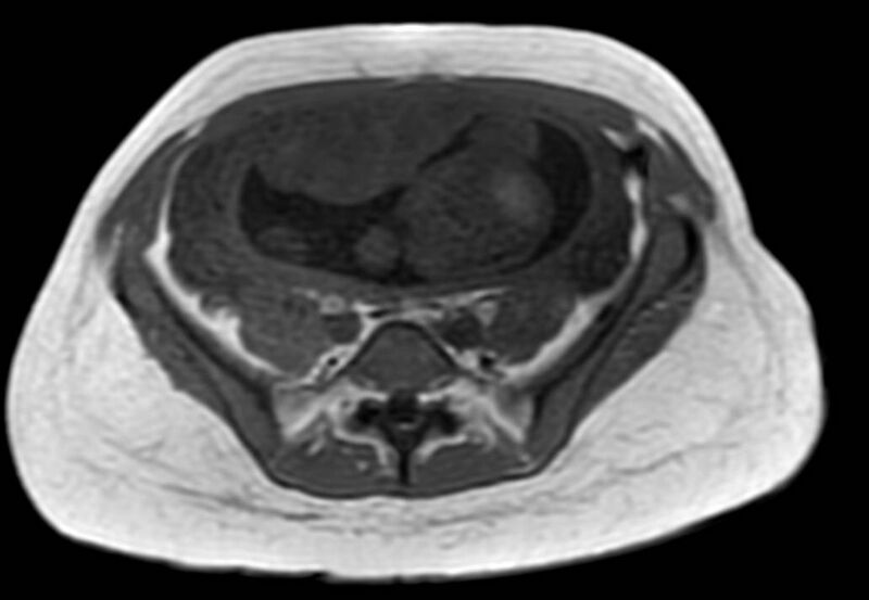 File:Appendicitis in gravida (MRI) (Radiopaedia 89433-106395 Axial T1 in-phase 47).jpg