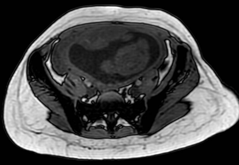 File:Appendicitis in gravida (MRI) (Radiopaedia 89433-106395 D 50).jpg