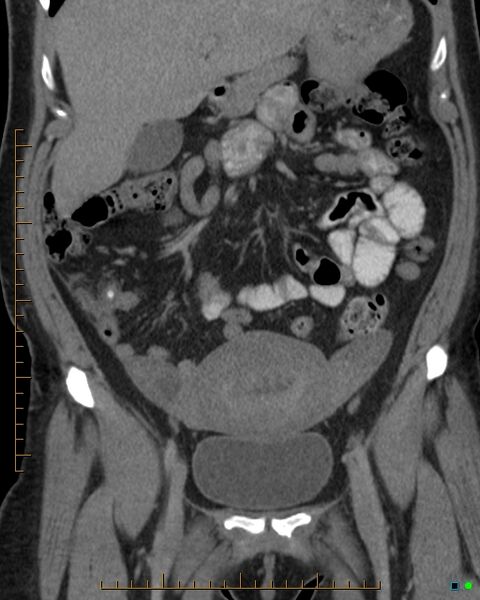 File:Appendicitis post recent cesarian section (Radiopaedia 29594-30102 D 2).jpg