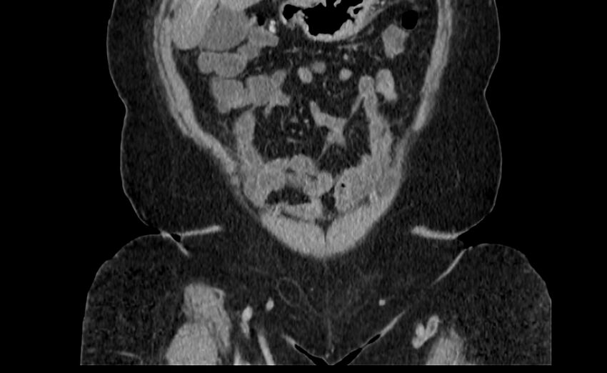 Appendix mucocele (Radiopaedia 41222-44033 B 5).jpg