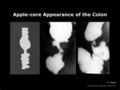 Apple-core appearance of the colon (Radiopaedia 21968-21959 B 1).jpg