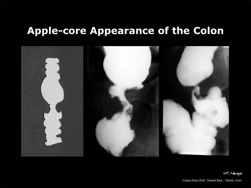 File:Apple-core appearance of the colon (Radiopaedia 21968-21959 B 1).jpg