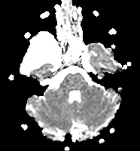 File:Arachnoid cyst- extremely large (Radiopaedia 68741-78451 Axial ADC 7).jpg
