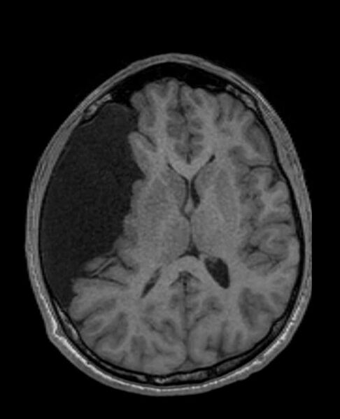 File:Arachnoid cyst- extremely large (Radiopaedia 68741-78451 Axial T1 43).jpg